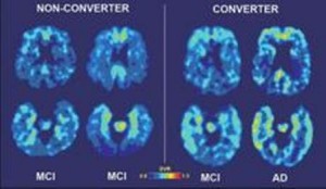 Сканирование мозга поможет определить, кто более подвержен когнитивным нарушениям